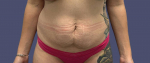 Abdominoplasty (Tummy Tuck) 22 Before